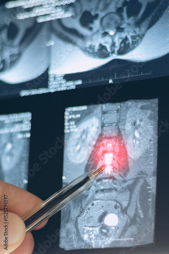 Examination vertical mri of inside herniated vertebral disk in spine, close up x-ray view.