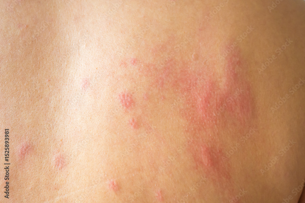 Fototapeta premium Young asian man itching and scratching on his back from allergic itchy dry skin eczema dermatitis insect bites