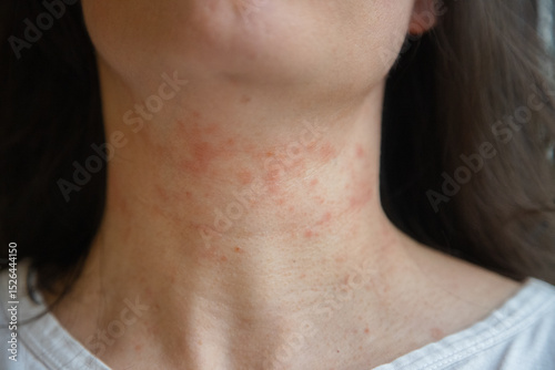 Close-up of a woman’s neck showing an allergic skin reaction with redness and irritation, likely due to eczema or atopic dermatitis. Captured indoors for dermatological reference photo