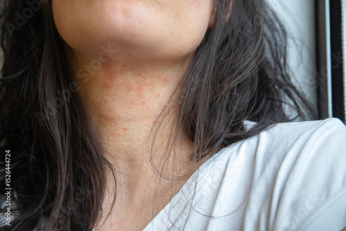 Close-up of a woman’s neck showing an allergic skin reaction with redness and irritation, likely due to eczema or atopic dermatitis. Captured indoors for dermatological reference photo