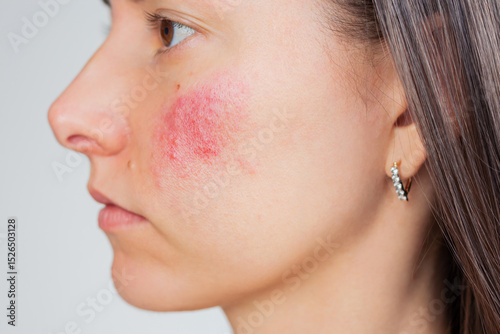 Profile of Young Caucasian woman suffering from rosacea on her face in the acute stage. Dermatological problems. Skin chronic disease