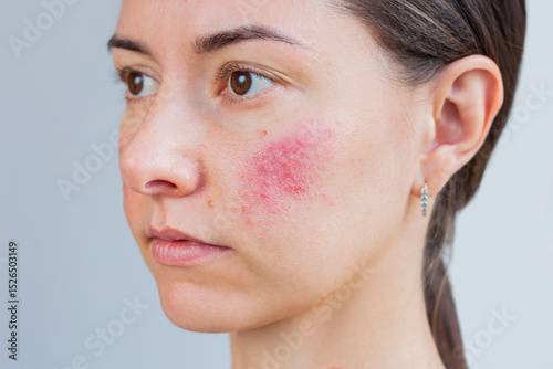 Young Caucasian woman suffering from rosacea on her face in the acute stage. Dermatological problems. Skin chronic disease