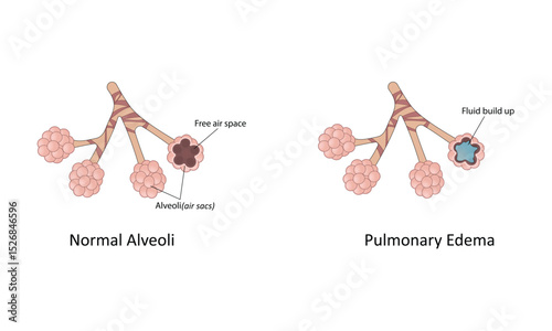 Pulmonary edema vector illustration