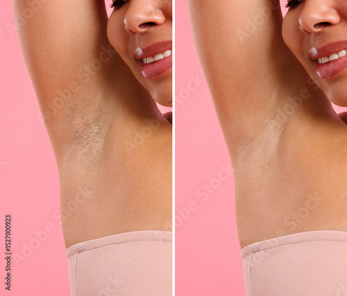Wallpaper Mural Before and after epilation. Woman showing armpit on pink background, closeup. Collage Torontodigital.ca