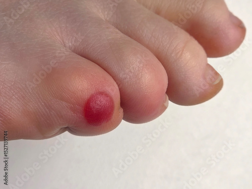 Close-Up of Toe with Callous or Red Blister Condition