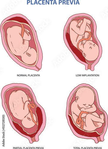 illustration of placenta previa types