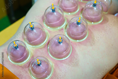 Close up for multiple vacuum cups, medical cupping therapy on human body. Doctor with cups for patient, therapy. Wellness, health injury rehabilitation concept. Alternative medicine