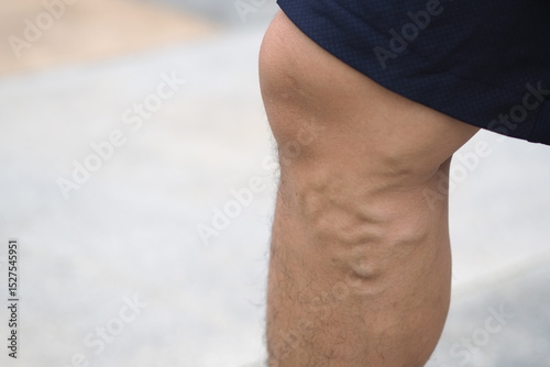 Varicose veins on the legs of men