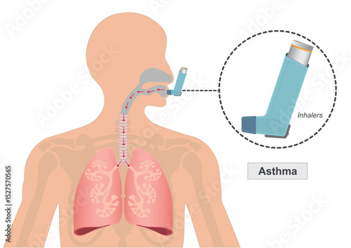 Asthma is a chronic lung disease affecting.