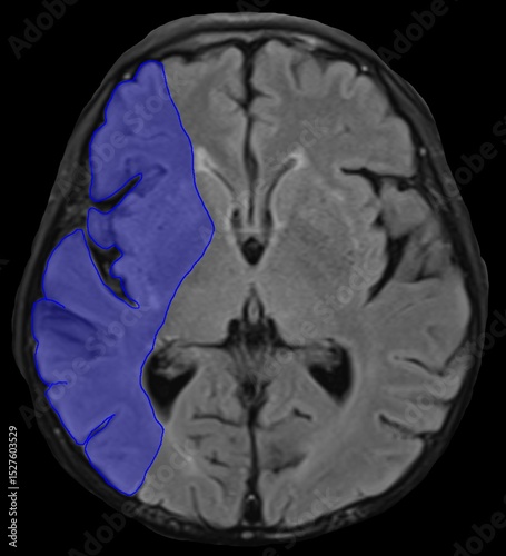 the distribution of right M1 segment