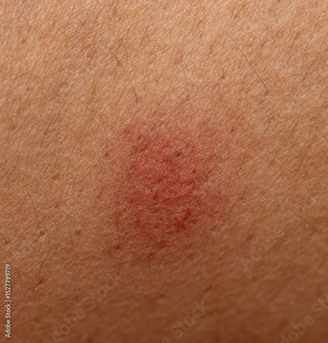 A red mark on a person's arm