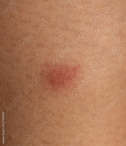 A red mark on a person's arm