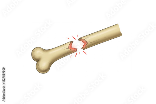High-quality scalable bone fracture graphic ideal for medical publications, educational materials, or website design, showcasing a detailed broken bone illustration.