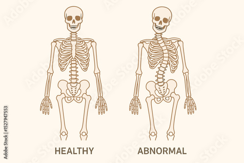 Scoliosis spine curvature vector illustration. Comparison of a healthy normal skeleton and an abnormal spine with scoliosis disease. Medical anatomy diagram for orthopedics and education.