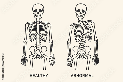 Scoliosis vector illustration comparing a healthy, straight spine with an abnormal, curved spine. Medical infographic of human skeleton anatomy, spinal curvature, and posture problems.