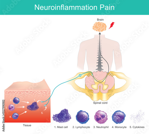 Neuroinflammation and Pain Pathway Diagram. Neuroinflammation process has an important role in of migraine.