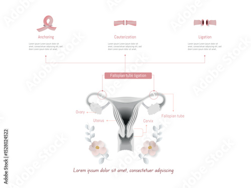 Fallopian tube ligation methods for family planning