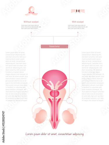 Vasectomy procedure, showing male reproductive system with and without scalpel