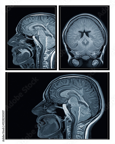 Hippocampus MRI scan. Brain MRI showing progressive hippocampal atrophy in a patient. photo