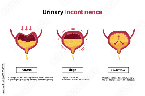 Type of Urinary Incontinence. Overactive bladder illustration. Bladder disease infographic