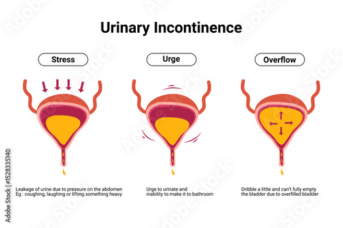 Type of Urinary Incontinence. Overactive bladder illustration. Bladder disease infographic