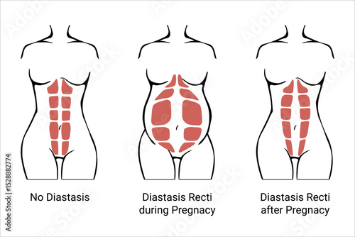 Different types of Diastasis. Diastasis in a woman before, during and after pregnancy. The anatomy of a Woman. A woman's muscular corset before and after childbirth. Vector illustration
