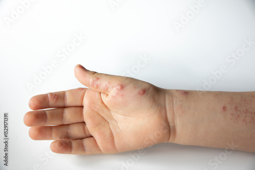 Herpes virus on a boy's hand. Herpes rash on a boy's body. The child is sick. Red spots on the hand. Childhood diseases.
