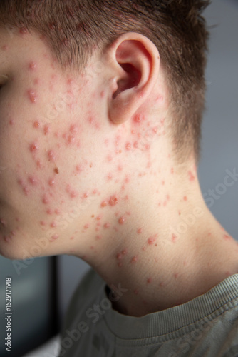 Chickenpox. Rash on the boy's body. The child has chickenpox. Red spots on the back. Childhood diseases.
