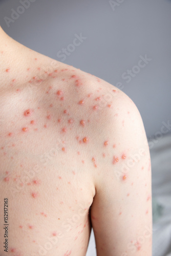 Chickenpox. Rash on the boy's body. The child has chickenpox. Red spots on the back. Childhood diseases.
