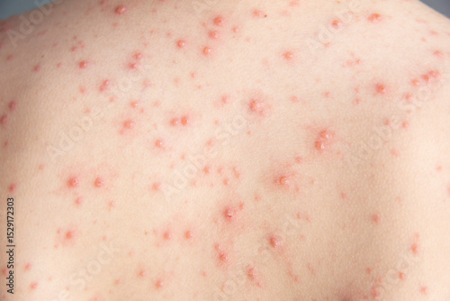 Chickenpox. Rash on the boy's body. The child has chickenpox. Red spots on the back. Childhood diseases.
