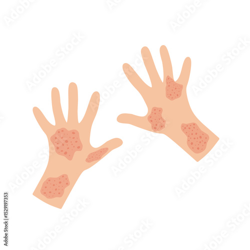 Illustration of a hand affected by allergies. Flat design illustration of a sick hand. Illustration of a hand with red bumps due to allergies