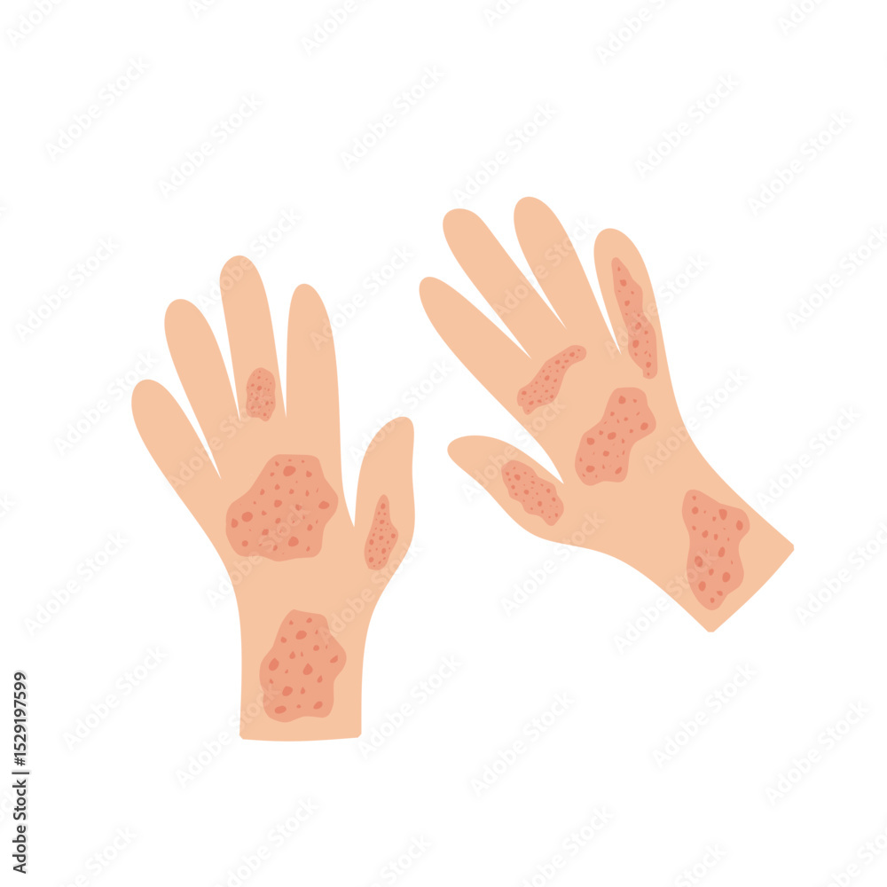 Fototapeta premium Illustration of a hand affected by allergies. Flat design illustration of a sick hand. Illustration of a hand with red bumps due to allergies