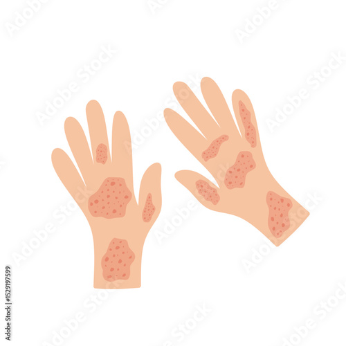 Illustration of a hand affected by allergies. Flat design illustration of a sick hand. Illustration of a hand with red bumps due to allergies