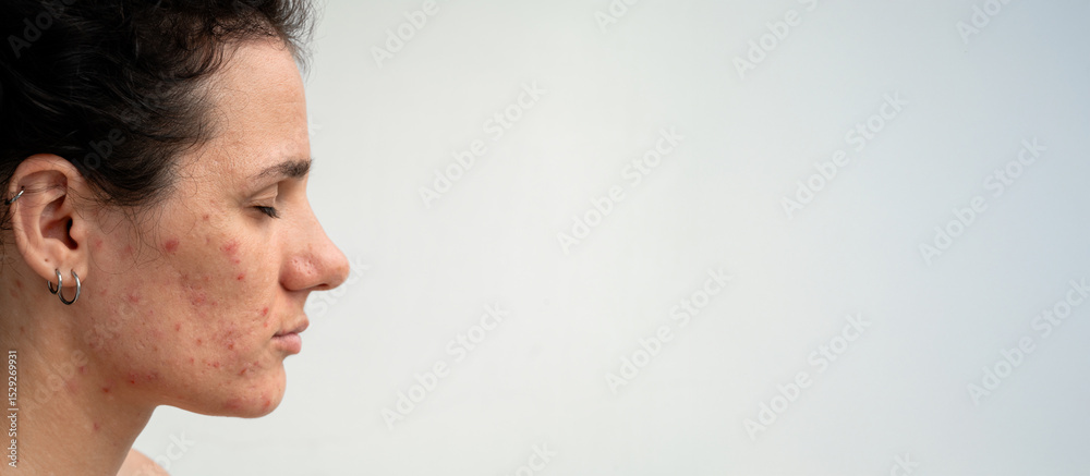 Obraz premium Close-up portrait of a young Caucasian woman with skin problems - pimples, acne, enlarged pores. A place for your text.