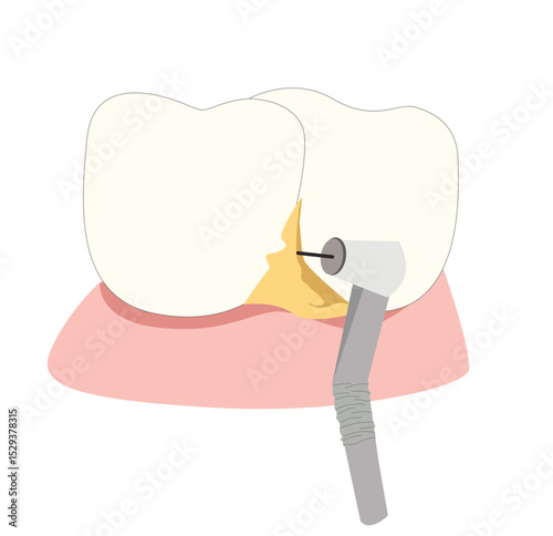 Dental cartoon of cleaning tooth by removing tartar from the teeth illustration