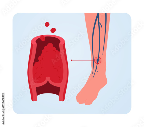 Deep vein thrombosis for healthcare infographic. Vector flat illustration. Vascular disease diagnostic and treatment. Human veins with DVT and blood clot. Design for health care, education