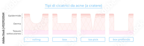 Illustrazione dei tipi di cicatrici da acne: rolling, box, ice pick, box profondo