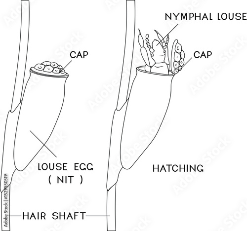 Coloring page with structure of head louse egg (nit) attached to a hair and louse hatching for biology lesson
