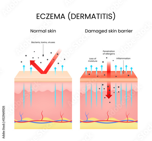 Eczema Damaged Skin vs Normal Skin