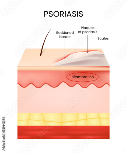 Psoriasis Cross Section of Skin Showing Plaques and Inflammation