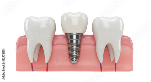 Wallpaper Mural Isolated Tooth Implant Torontodigital.ca