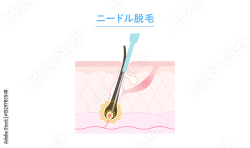 ニードル脱毛のしくみ 断面図