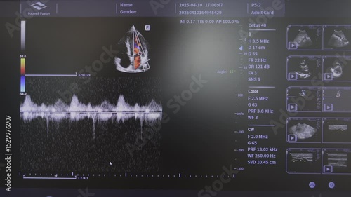 Echocardiogram screen with Doppler waveform and heart chamber scan, Cardiac ultrasound shows blood flow velocity and structural heart imaging