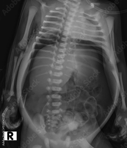 Pneumoperitoneum, the presence of air within the peritoneal cavity. photo