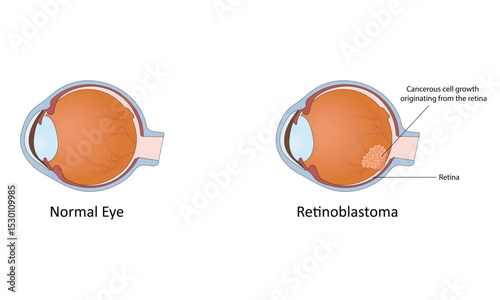  Retinoblastoma vector illustration