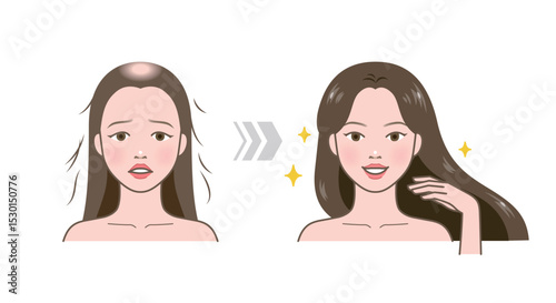 Before and after of hair loss versus hairy. Woman character with hair problem of baldness. Hair regrowth.