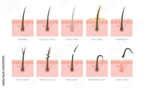 Types of hair problems. Normal, split ends, open cuticle, breakage, ingrown, dandruff, damaged, hair loss, cuticle loss, oily hair and gray hair.