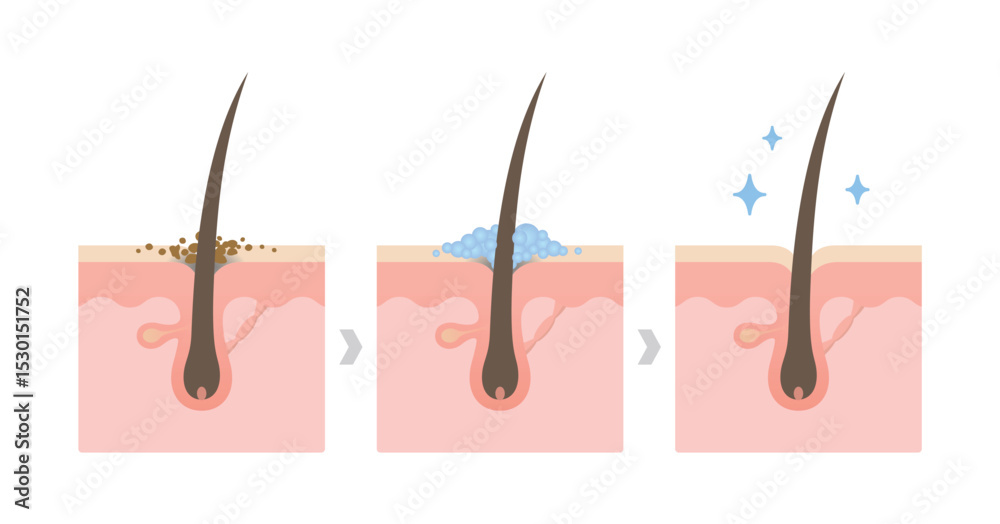 Αυτοκόλλητο Comparison of dandruff and healthy hair on scalp layer vector illustration