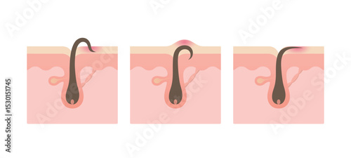 Types of ingrown hair. Hair has grown back into the skin surface. Structure of human hair follicle.