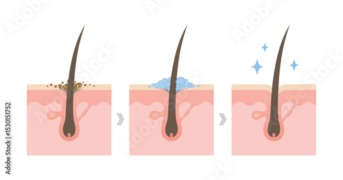 Comparison of dandruff and healthy hair on scalp layer vector illustration. Cross section of scalp. Cleansing the scalp.